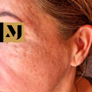 Melasma y lentigo solar antes de tratamiento