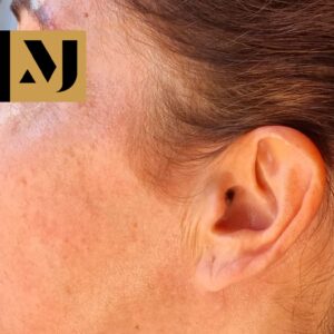 Melasma y lentigo solar después del tratamiento